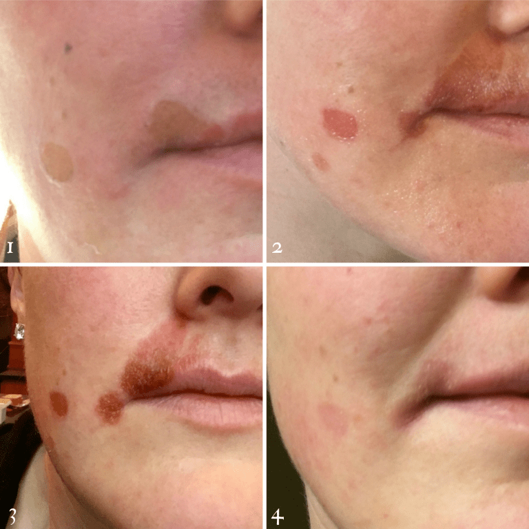 I Burned My Face with Hot Cooking Oil. Here’s What Happened