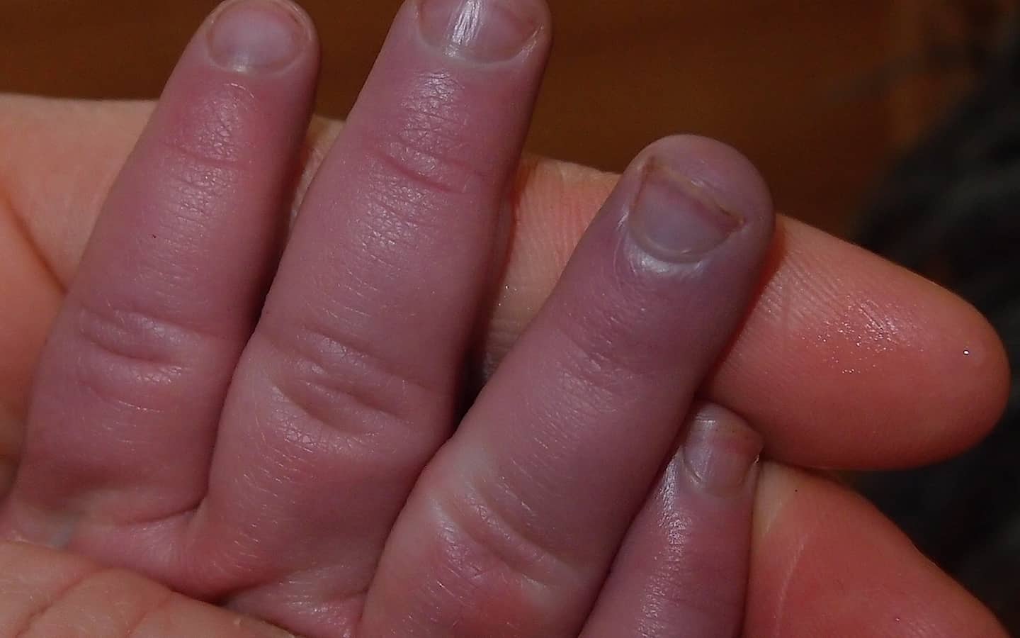 Почему ногти синеют причина. Вирус Коксаки слоятся ногти.